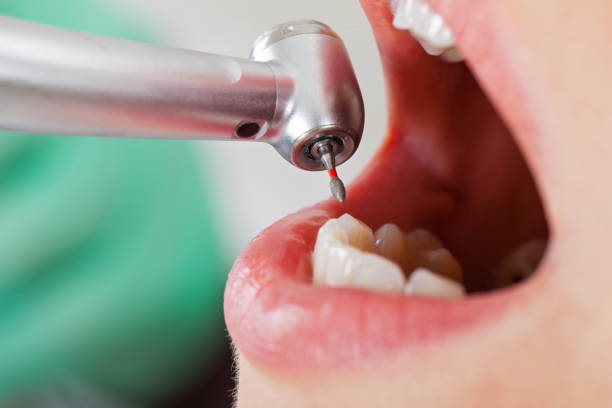 Best Emergency Tooth Extraction in Markham, IL